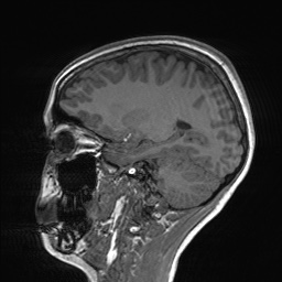 File:Cerebral cavernous venous malformation (Radiopaedia 70008-80021 Sagittal T1 26).jpg