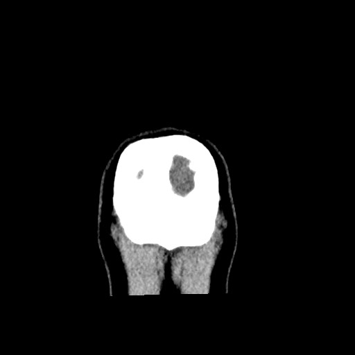 Cerebral cavernous venous malformation (Radiopaedia 70008-80022 non-contrast 69).jpg