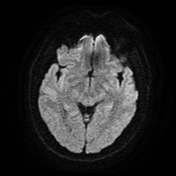 File:Cerebral cavernous venous malformation (Zabramski type II) (Radiopaedia 85511-101198 Axial DWI 48).jpg