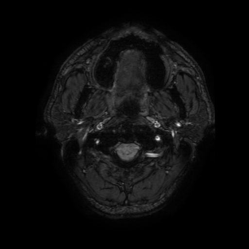 Cerebral cavernous venous malformation (Zabramski type II) (Radiopaedia 85511-101198 Axial SWI 1).jpg