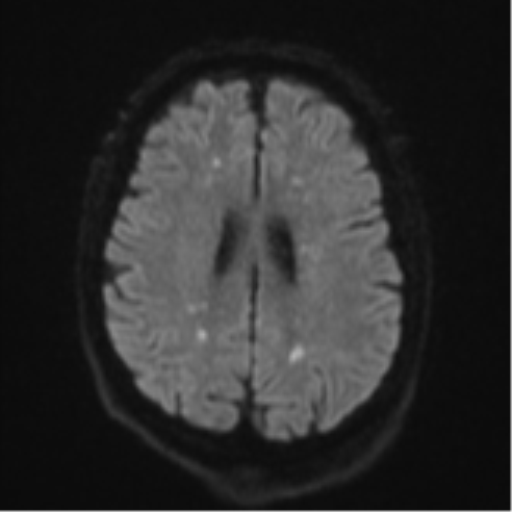 Cerebral embolic infarcts (embolic shower) (Radiopaedia 57395-64342 Axial DWI 60).png