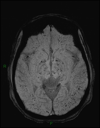 Cerebral fat embolism (Radiopaedia 35022-36525 Axial SWI 13).jpg