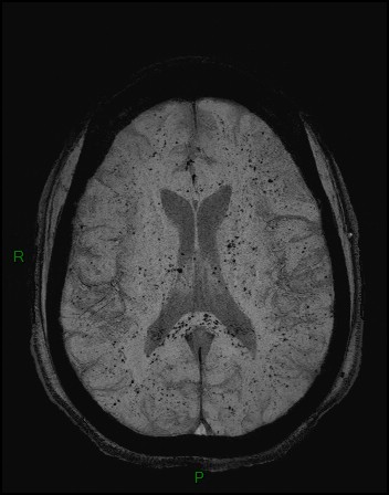 Cerebral fat embolism (Radiopaedia 35022-36525 Axial SWI 26).jpg