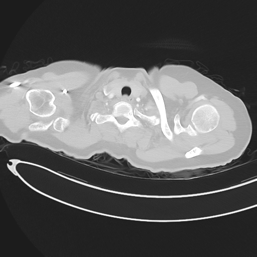 Cerebral metastases (Radiopaedia 33041-34055 Axial lung window 5).png