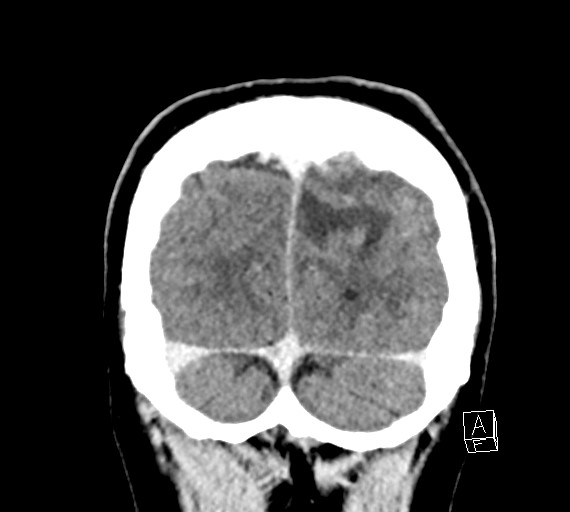 Cerebral metastases - testicular choriocarcinoma (Radiopaedia 84486-99855 D 55).jpg