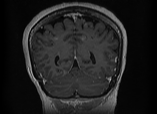 File:Cerebral metastases from lung cancer with amyloid angiopathy and cerebellopontine angle meningioma (Radiopaedia 74306-85191 Coronal T1 C+ 46).jpg