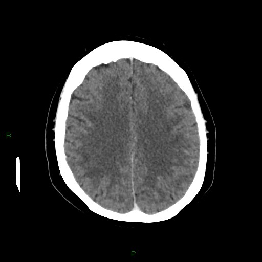 File:Cerebral metastasis from renal cell carcinoma (Radiopaedia 82306-96375 Axial C+ delayed 26).jpg