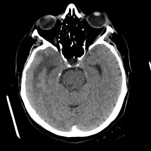 Cerebral metastasis to basal ganglia (Radiopaedia 81568-95412 Axial non-contrast 24).png