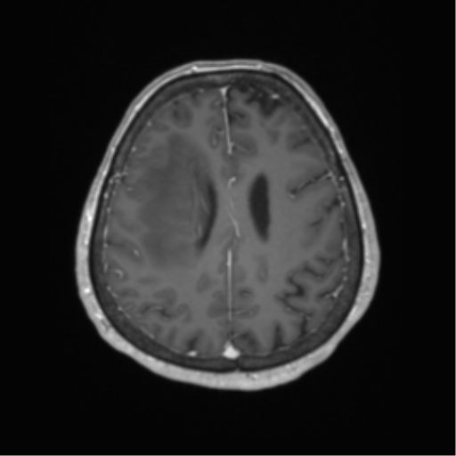 Cerebral metastasis to basal ganglia (Radiopaedia 81568-95413 Axial T1 C+ 53).png