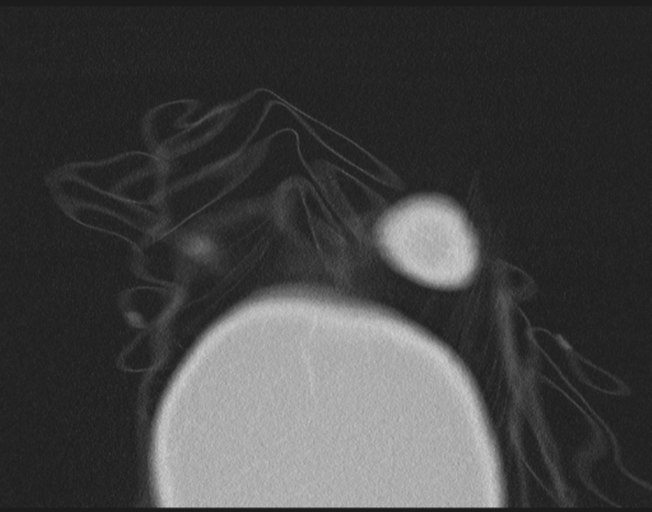 Cerebral metastasis to basal ganglia (Radiopaedia 81568-95414 Coronal lung window 3).png