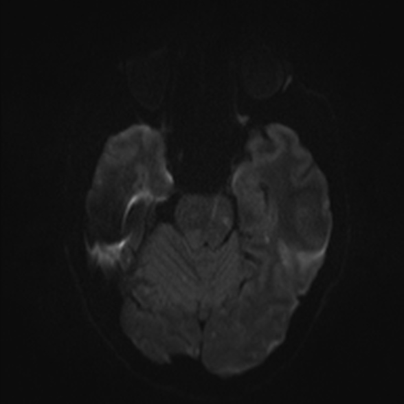 Cerebral toxoplasmosis (Radiopaedia 53993-60132 Axial DWI 36).jpg