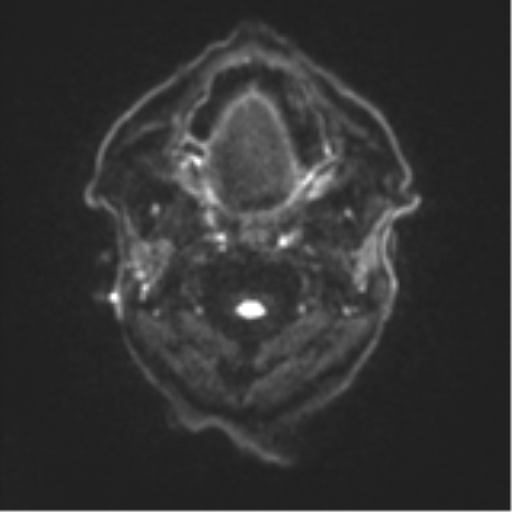 Cerebral toxoplasmosis (Radiopaedia 54575-60804 Axial DWI 33).png