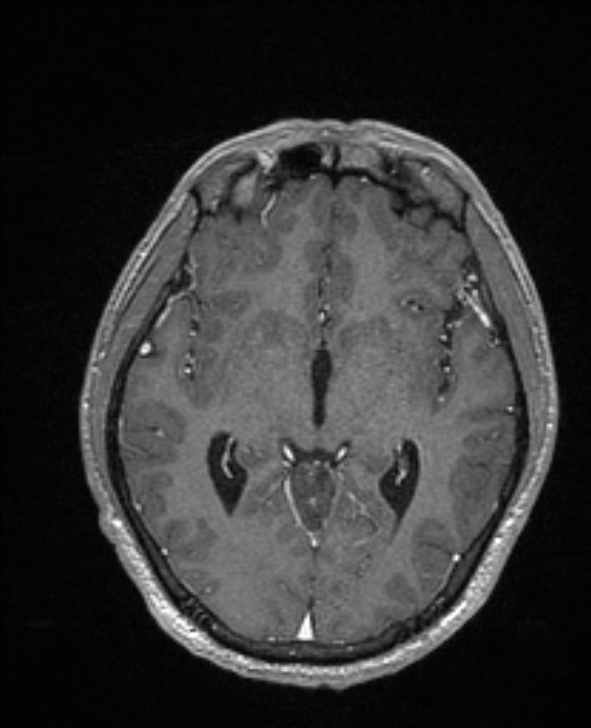 Cerebral toxoplasmosis (Radiopaedia 85779-101597 Axial T1 C+ 77).jpg