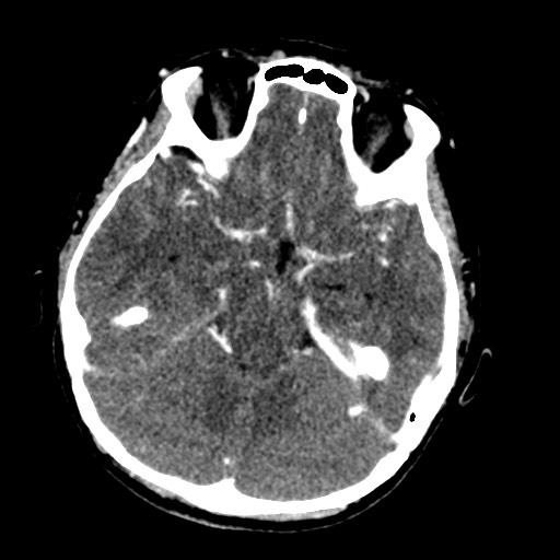 File:Cerebral tuberculosis with dural sinus invasion (Radiopaedia 60353-68019 Axial C+ delayed 21).jpg