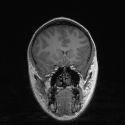 Cerebral tuberculosis with dural sinus invasion (Radiopaedia 60353-68090 Coronal T1 66).jpg