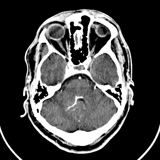 File:Cerebral venous angioma (Radiopaedia 69959-79977 B 15).jpg