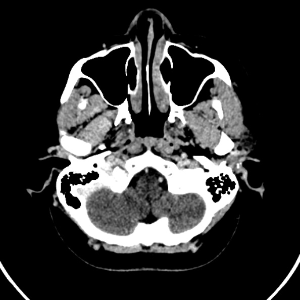 Cerebral venous hemorrhagic infarct from venous sinus thrombosis (Radiopaedia 55433-61883 Axial C+ delayed 131).jpg