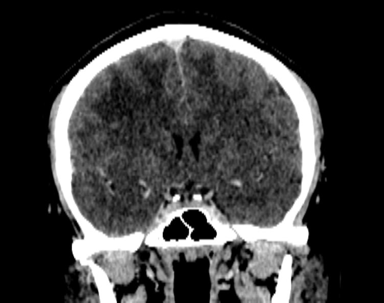 Cerebral venous hemorrhagic infarct from venous sinus thrombosis (Radiopaedia 55433-61883 Coronal C+ delayed 30).jpg