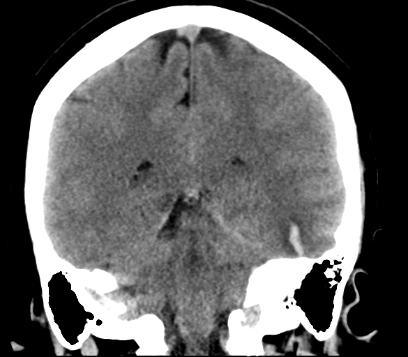 File:Cerebral venous infarction due to transverse sinus thrombosis (Radiopaedia 34688-36116 Coronal non-contrast 24).png