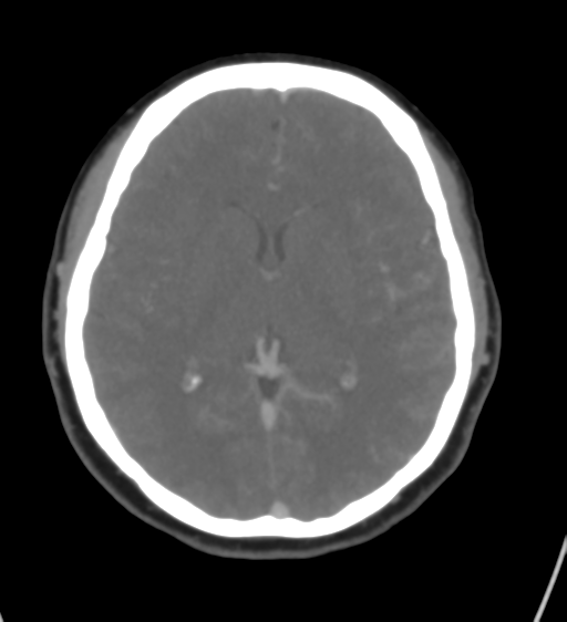 Cerebral venous infarction due to transverse sinus thrombosis (Radiopaedia 34688-36120 Axial CT venogram 27).png
