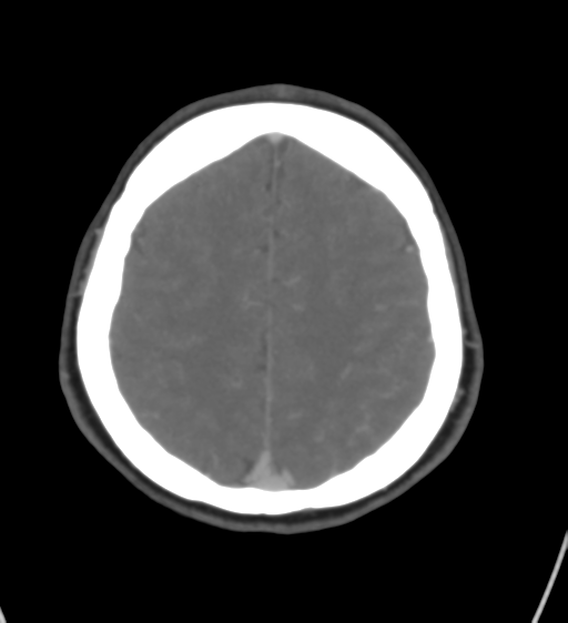 Cerebral venous infarction due to transverse sinus thrombosis (Radiopaedia 34688-36120 Axial CT venogram 39).png