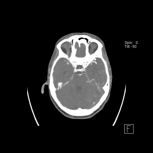 Cerebral venous infarction with hemorrhage (Radiopaedia 65343-74396 A 37).jpg