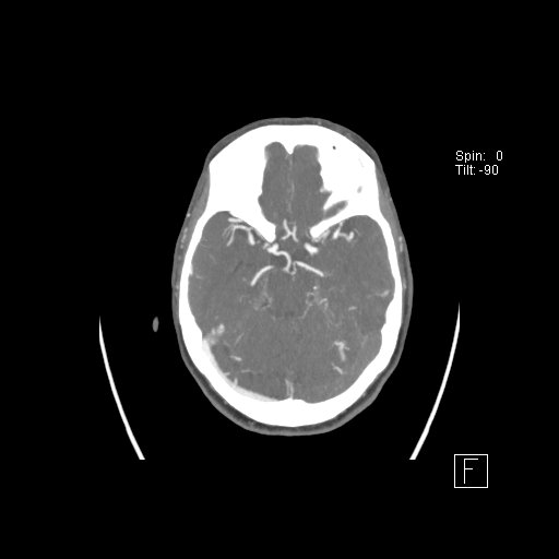 Cerebral venous infarction with hemorrhage (Radiopaedia 65343-74396 A 42).jpg