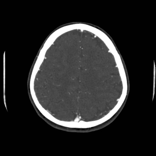 Cerebral venous sinus thrombosis (Radiopaedia 40619-43227 A 177).jpg
