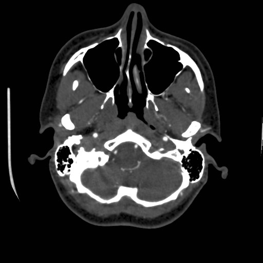 Cerebral venous sinus thrombosis (Radiopaedia 40619-43227 A 30).jpg