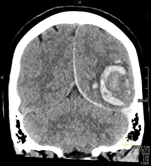 Cerebral venous sinus thrombosis (Radiopaedia 91329-108965 Coronal non-contrast 43).jpg