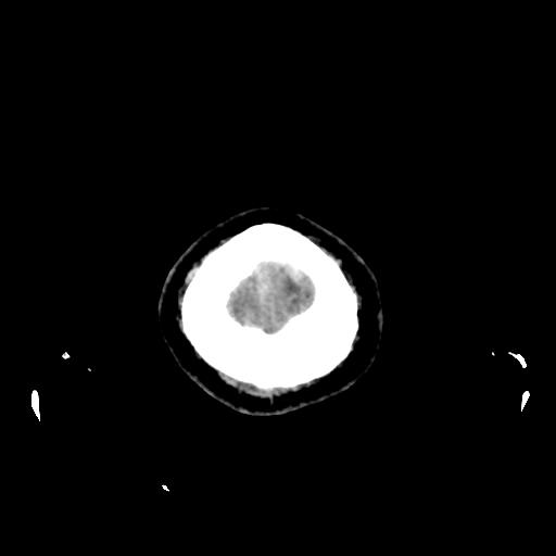 Cerebral venous throbmosis - hemorrhagic venous infarction (Radiopaedia 87318-103613 Axial non-contrast 174).jpg