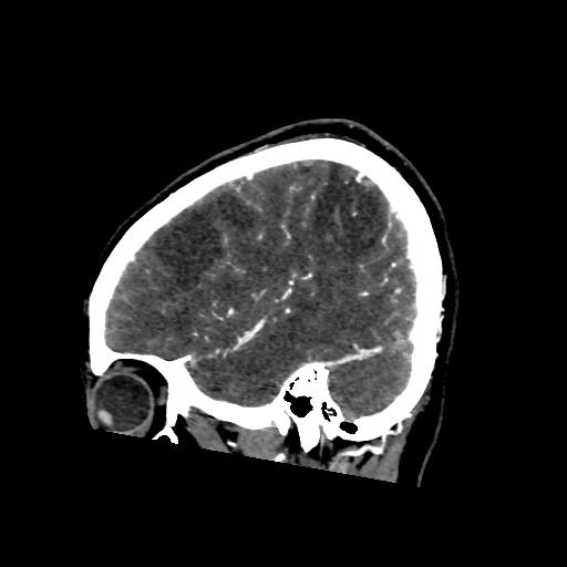 File:Cerebral venous throbmosis - hemorrhagic venous infarction (Radiopaedia 87318-103613 Sagittal CT venogram 8).jpg