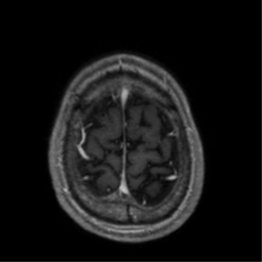 Cerebral venous thrombosis (Radiopaedia 38392-40469 Axial T1 C+ 70).png