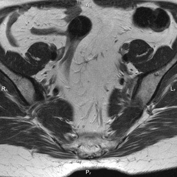 File:Cervical adenocarcinoma (Radiopaedia 65011-73985 Axial T2 31).jpg