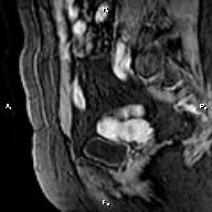 File:Cervical adenocarcinoma (Radiopaedia 65011-73985 E 6).jpg