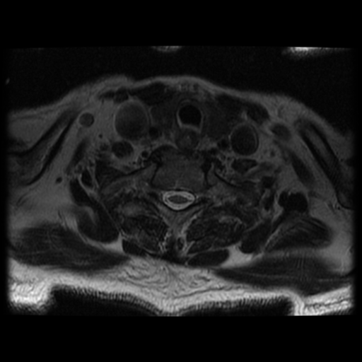 File:Cervical canal stenosis with cord compression (Radiopaedia 34114-35374 Axial T2 12).png