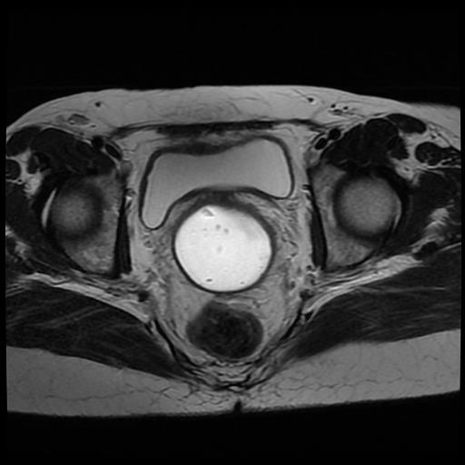 File:Cervical cancer (Radiopaedia 62991-71413 Axial T2 12).jpg