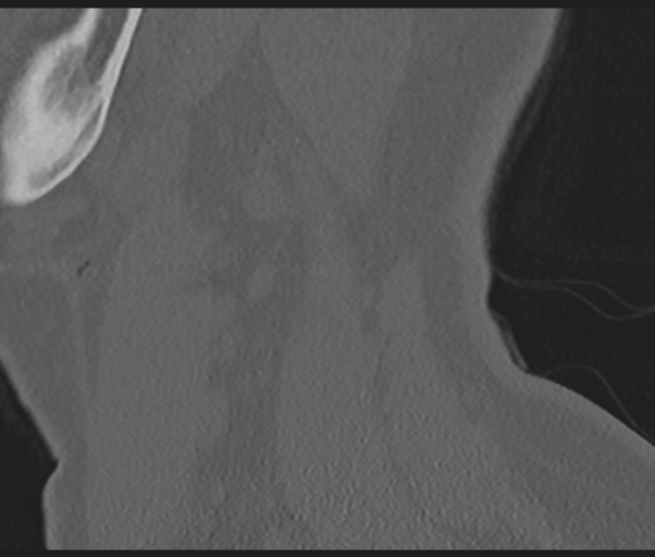 Cervical disc replacement (Radiopaedia 44025-47541 Sagittal bone window 75).png