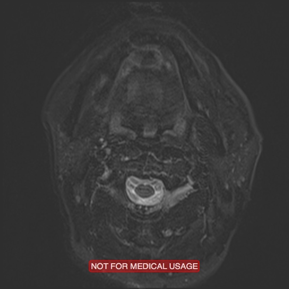 Cervical nerve schwannoma (Radiopaedia 27964-28221 C 24).jpg