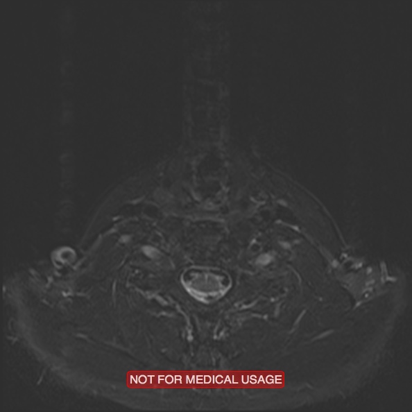 Cervical nerve schwannoma (Radiopaedia 27964-28221 C 40).jpg