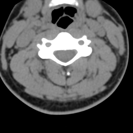 Cervical schwannoma (Radiopaedia 57979-64974 Axial non-contrast 31).png