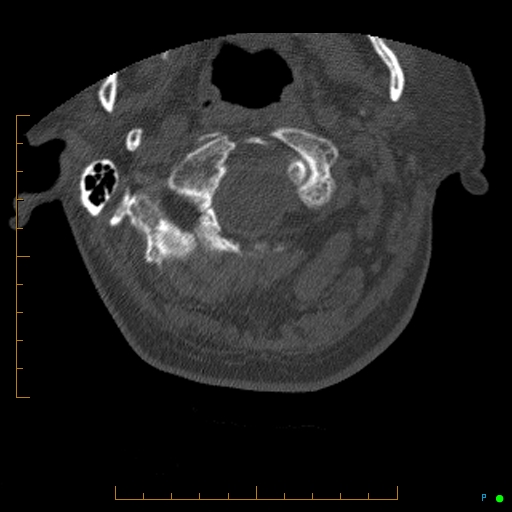 Cervical spine fracture - ankylosing spondylitis (Radiopaedia 76835-88706 Axial bone window 16).jpg