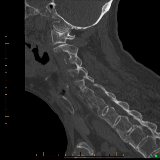Cervical spine fracture - ankylosing spondylitis (Radiopaedia 76835-88706 Sagittal bone window 43).jpg