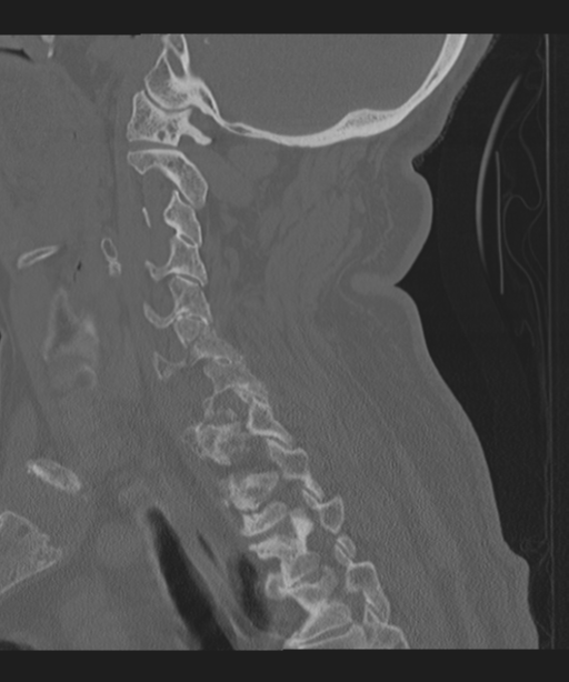 Cervical spine fracture in the setting of ankylosis (Radiopaedia 37038-38715 Sagittal bone window 52).png
