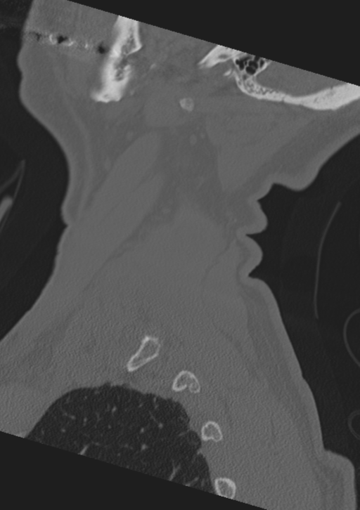 Cervical spine fractures with vertebral artery dissection (Radiopaedia 53296-59268 Sagittal bone window 65).png