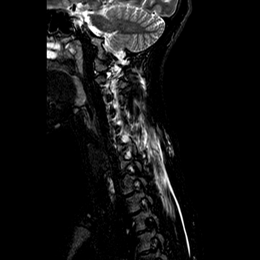 File:Cervical spine posterior ligamentous complex rupture (Radiopaedia 63486-72103 Sagittal STIR 10).jpg