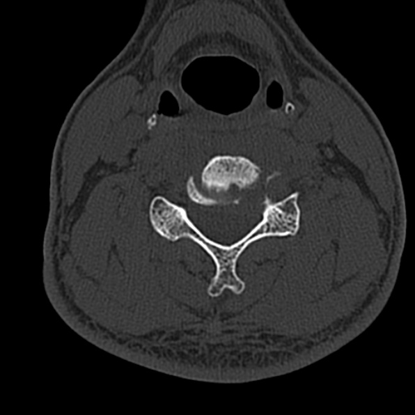 Cervical spondylodiscitis (Radiopaedia 28057-29489 Axial bone window 44).jpg