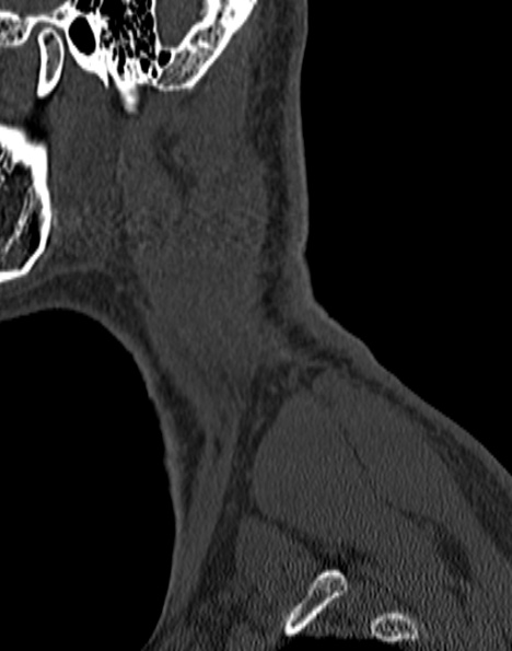 Cervical spondylodiscitis (Radiopaedia 28057-29489 Sagittal bone window 6).jpg