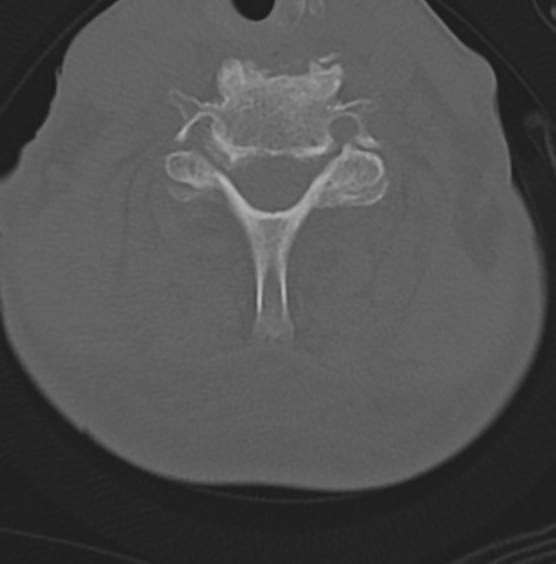 Cervical spondylolysis (Radiopaedia 49616-54811 Axial bone window 38).png