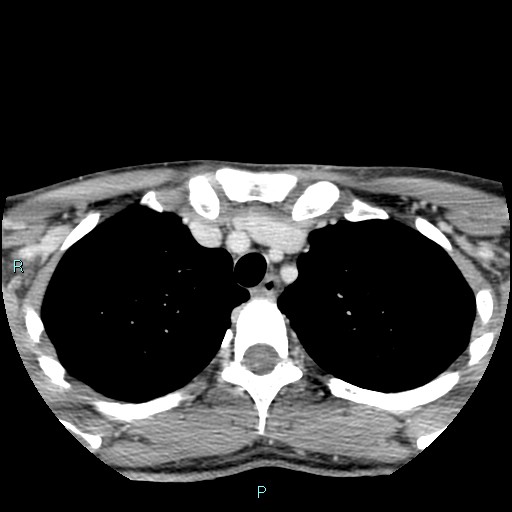 File:Cervical thymic cyst (Radiopaedia 88632-105335 C 12).jpg